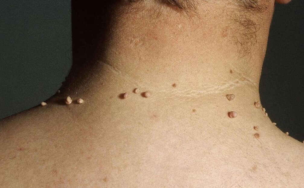 Causas de papilomas en el cuello.