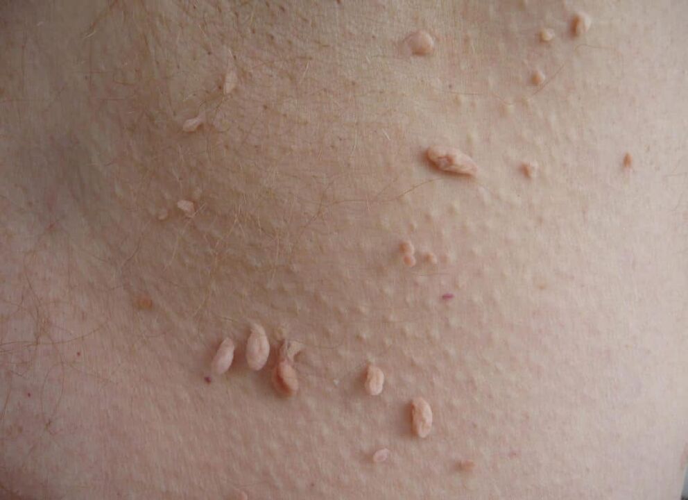 Tipos de papilomas en el cuello.