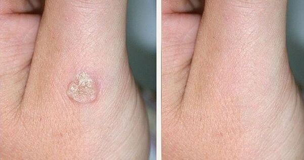 Fotos antes y después de eliminar las verrugas con remedios naturales.