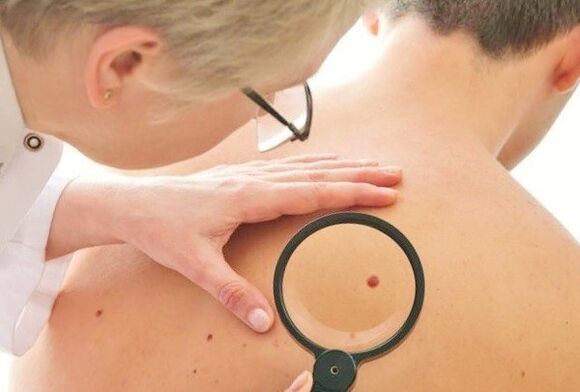 El médico determina el tipo de papiloma en la piel.