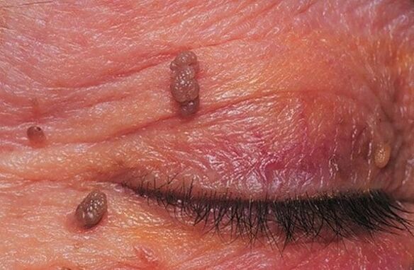 Foto de un papiloma en el párpado.