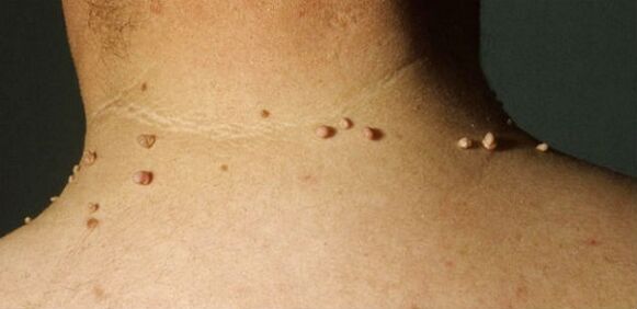 ¿Cómo se ve un papiloma en el cuello