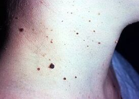 papilomas oscuros en el cuello de una persona
